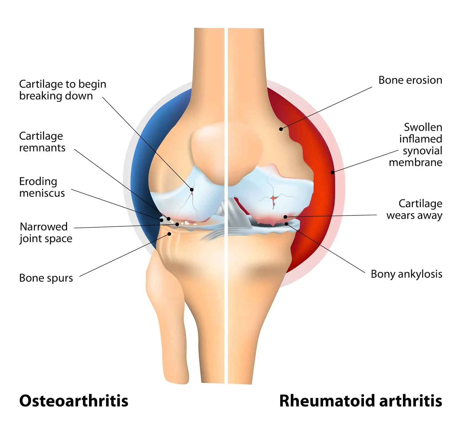 arthritis